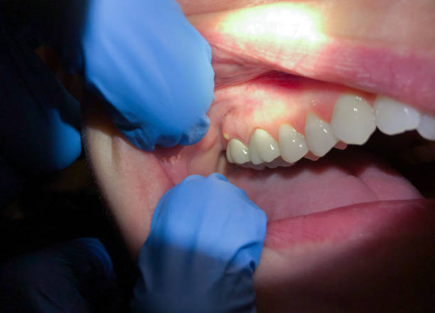 Best Emergency Dental Care for Broken or Chipped Teeth in Guerneville, CA